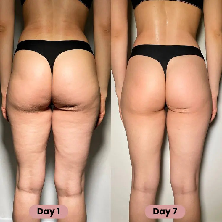 Nouvea™ -  Cellulite Massager Boutique Nouvea